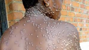 Namibia-Mpox