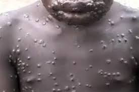 Osun-Mpox