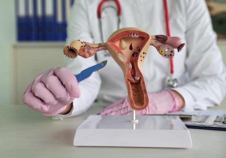 Reasons for uterine removal. Doctor scalpel uterus and surgery. Amputation of uterus and appendages. Hysterectomy of the uterus