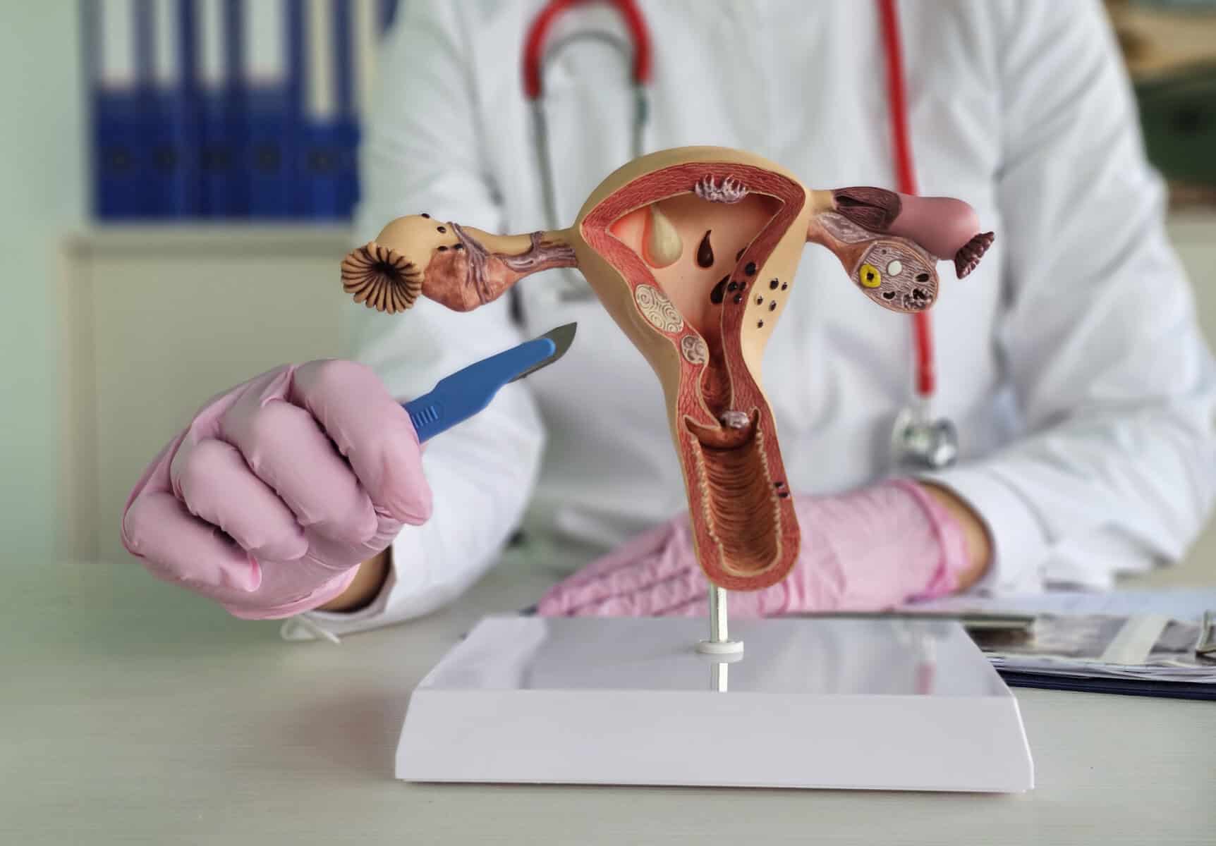 Reasons for uterine removal. Doctor scalpel uterus and surgery. Amputation of uterus and appendages. Hysterectomy of the uterus