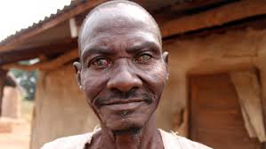 Kogi-river-blindness